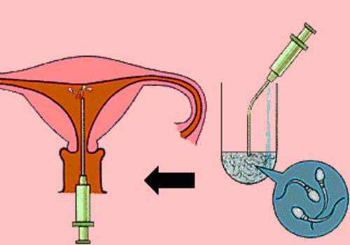 盤點試管嬰兒希愛力的正確使用方法，注意時間和劑量才是關鍵